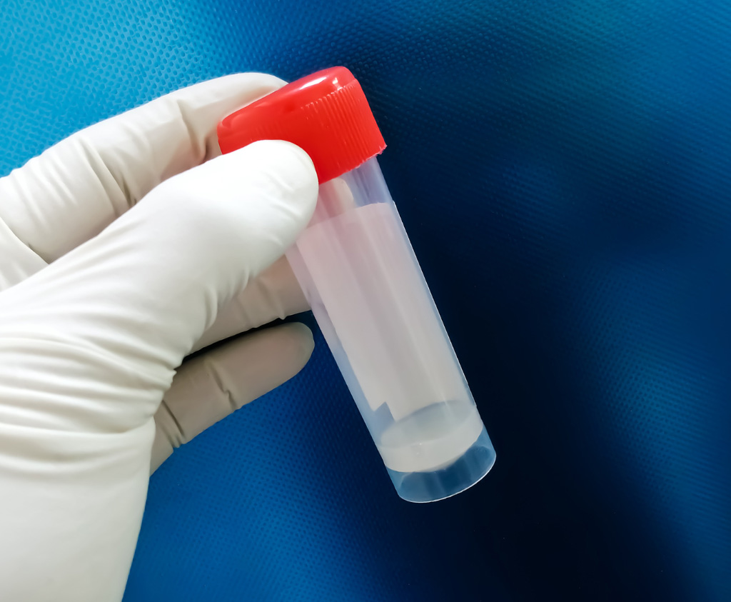 Semen Analysis in Murrieta & Beverly Hills: Get Accurate Results